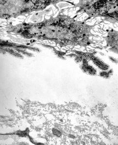 M, 22y. | epidermolysis bullosa - junctional type, uncompletely separated basement membrane